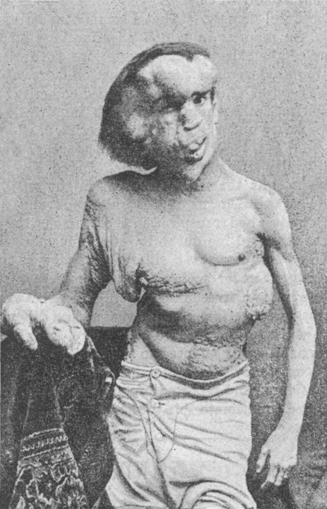 Joseph Merrick o de elephant man